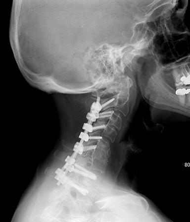 Cervical laminectomy and fusion