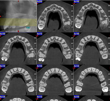 CBCT Maxilla Axial Set