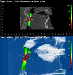 Airway Most Constricted