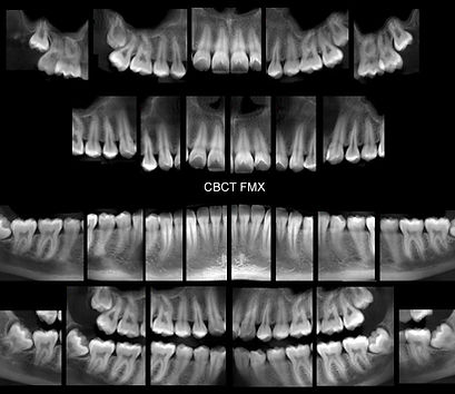 2D Dental Full Mouth X-Ray