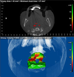 Airway Most Constricted_002