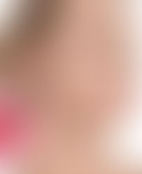 "Everything About Skin Boosters Injections in Dubai"