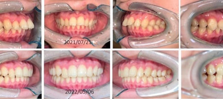 如何利用早期矯正，成功解決II類咬合不正