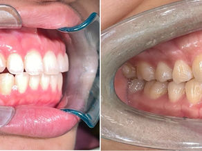 Invisalign隱形矯正結果與預期差異：後牙咬合接觸的研究