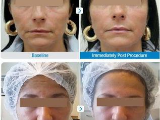 HIFU for skin tightening and lifting