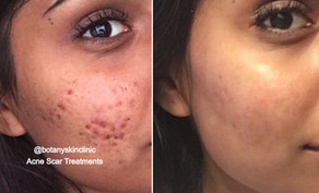 Acne Scar Treatments