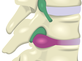 Spinal Decompression Therapy