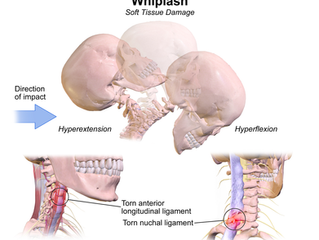 Suffering from Whiplash? Physical Therapy Can Help!