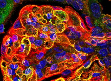University of Bristol: Breakthrough blood test could detect heart and kidney disease earlier than ever before
