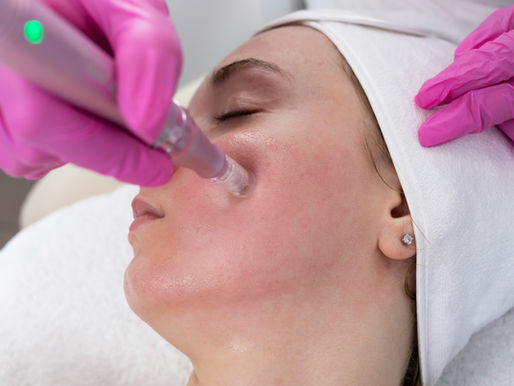 Biostimulatoren of fillers? Ontdek de verschillen | Refined Aesthetics Barendrecht