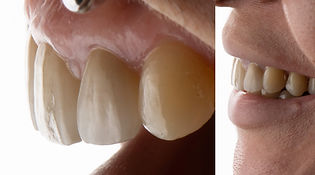 Caso 3 de Implantes Dentales