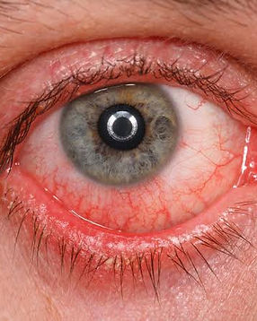 Qué es la conjuntivitis.jpg