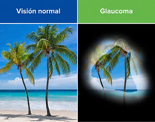 glaucoma.png