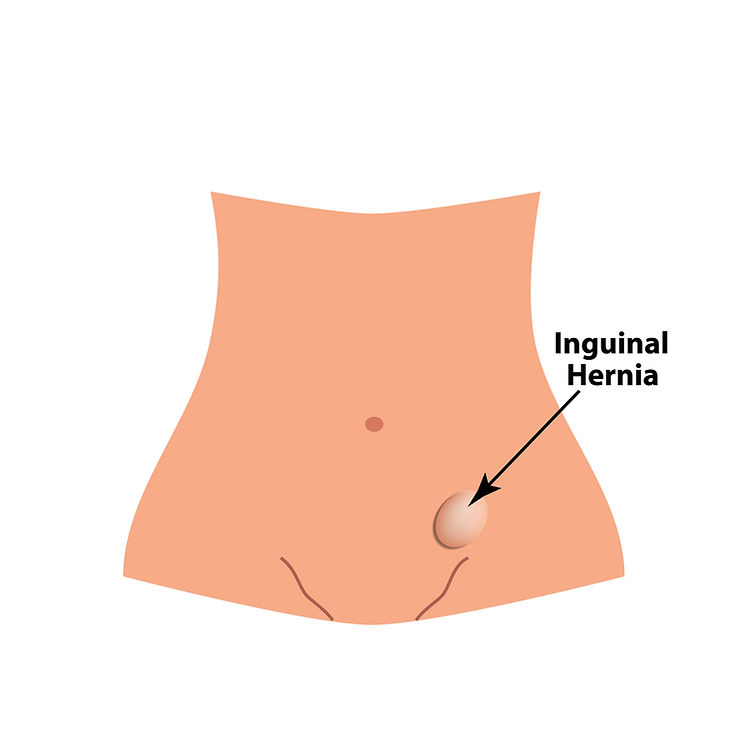 121kb inguinal 200818.jpg
