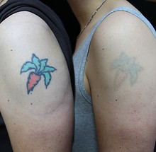 Tattoo Removal