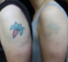 Tattoo Removal
