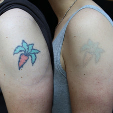Tattoo Removal
