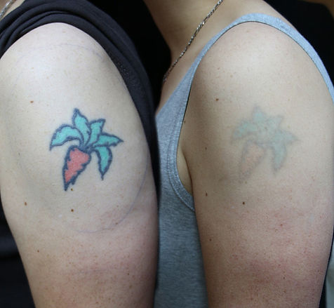Tattoo Removal