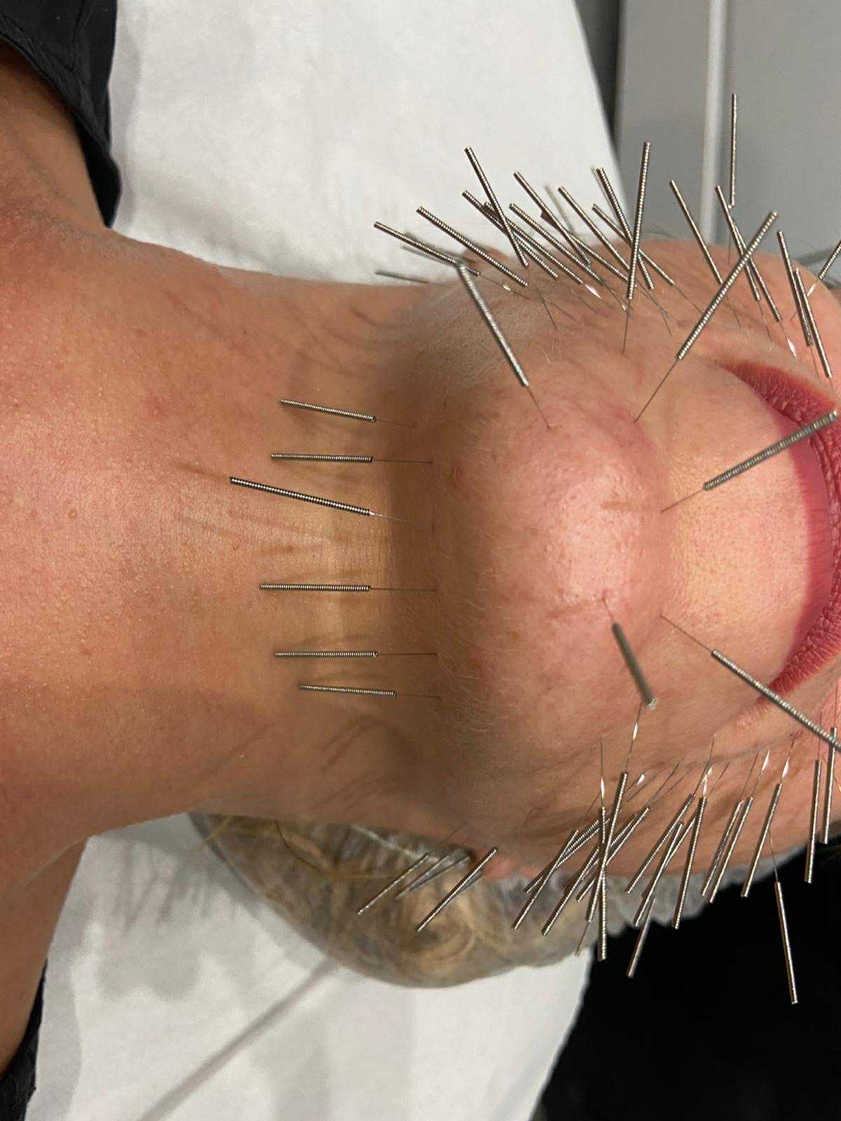 Aesthetic Acupuncture