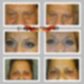 מטופלים לפני ואחרי הטיפול באינסטנטלי אייג'לס ¬| להעלמת קמטים בעור ושקיות מתחת לעיניים