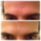 העלמה | טשטוש צלקת במצח באמצעות אינסטנטלי אייג'לס