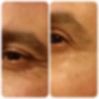 מטופל לפני ואחרי טיפול באינסטנטלי אייג'לס | העלמת קמטים בעור