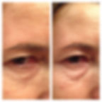 תמונה הממחישה תוצאה של טיפול באינסטנטלי אייג'לס. מימין לפני הטיפול משמאל אחרי הטיפול. רואים את ההבדל.