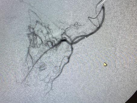 Uncommon Origins to the Prostatic Artery