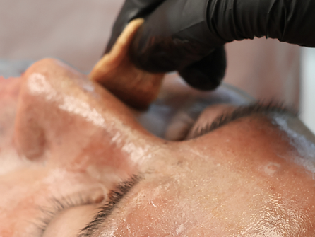 The Perfect Derma Peel