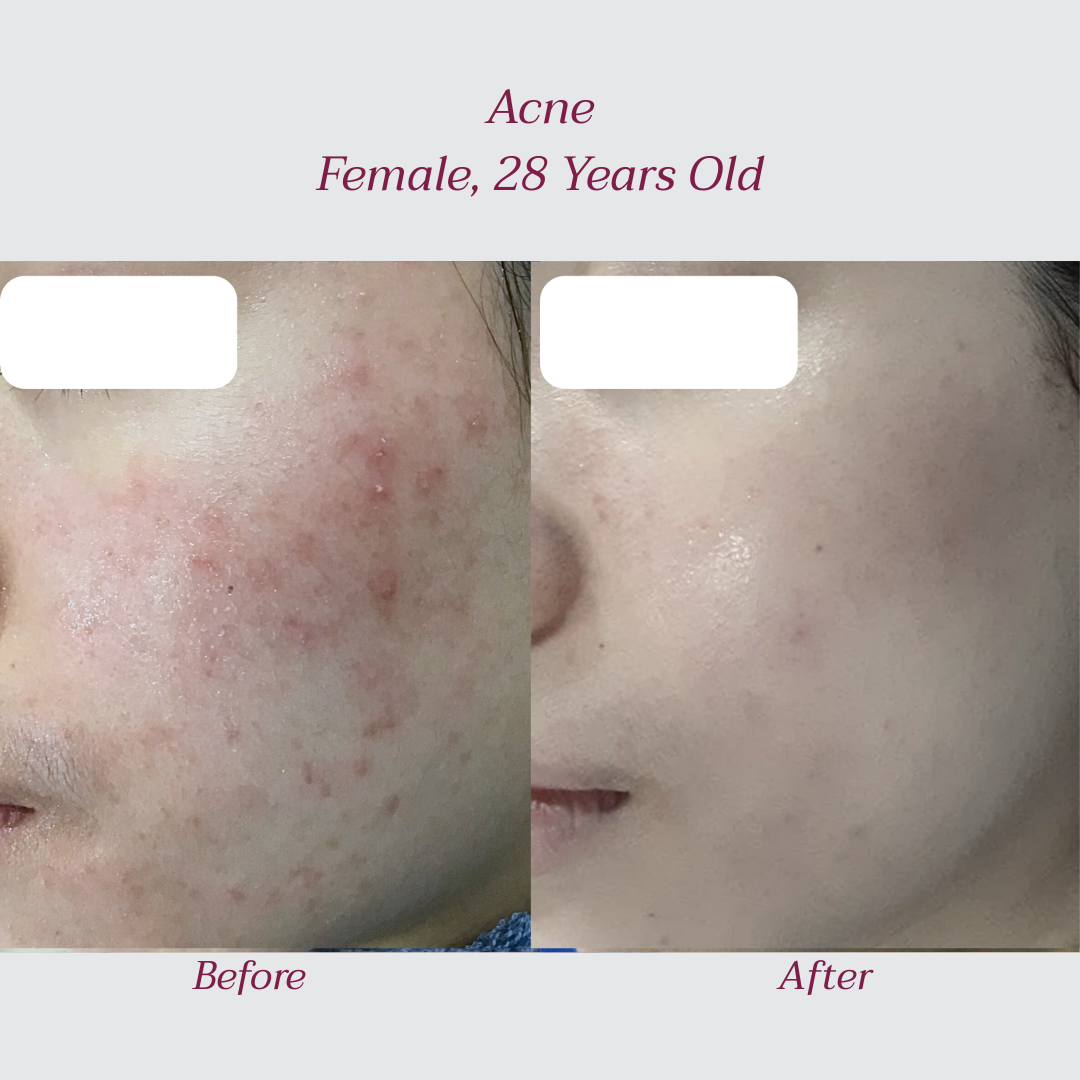 Reglo_Acne2.png
