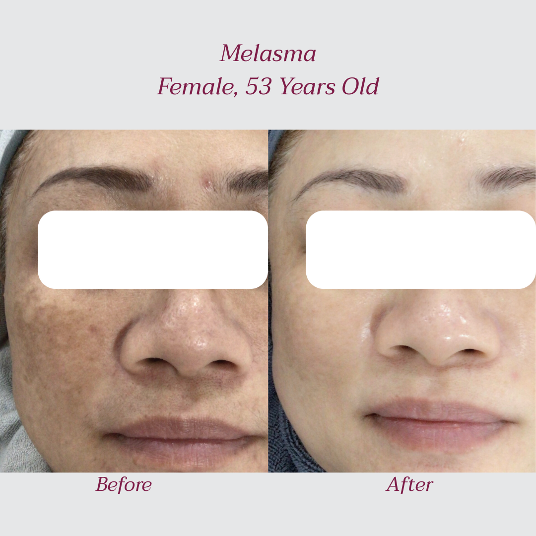 Reglo_Melasma1.png