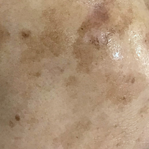 Pigmentation.png