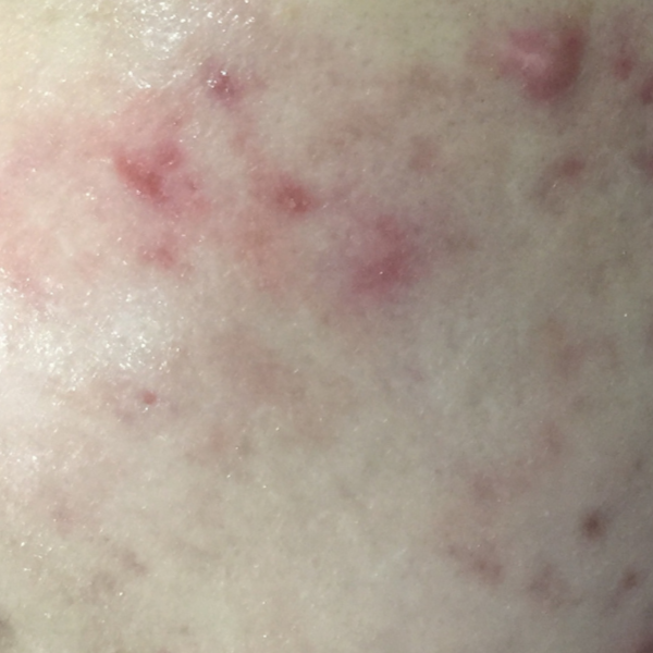 Acne Skin.png