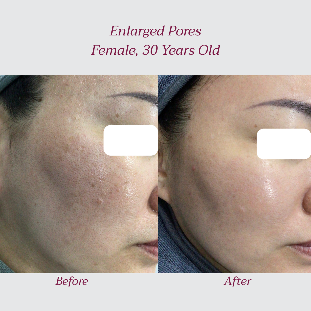 Reglo_Pores1.png