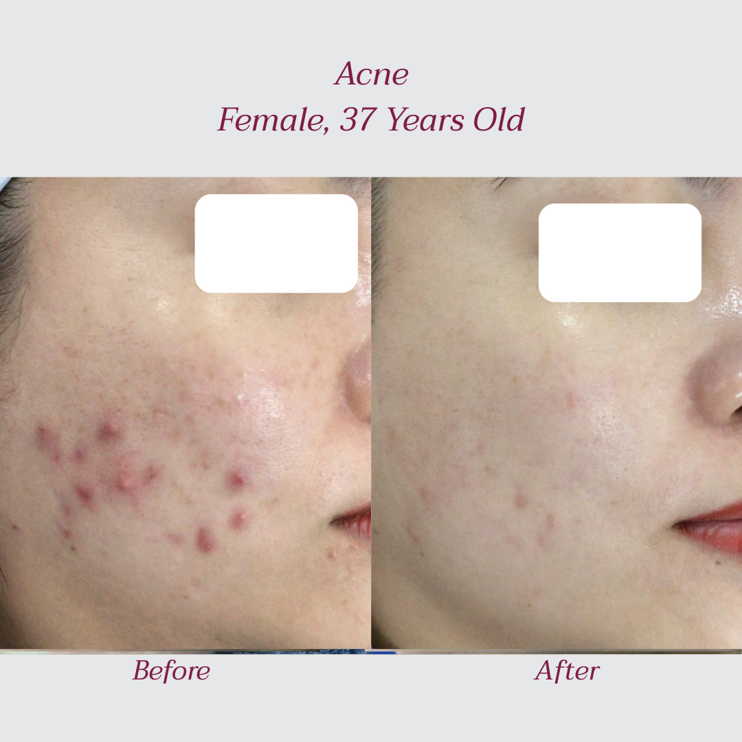 Reglo_Acne3.png