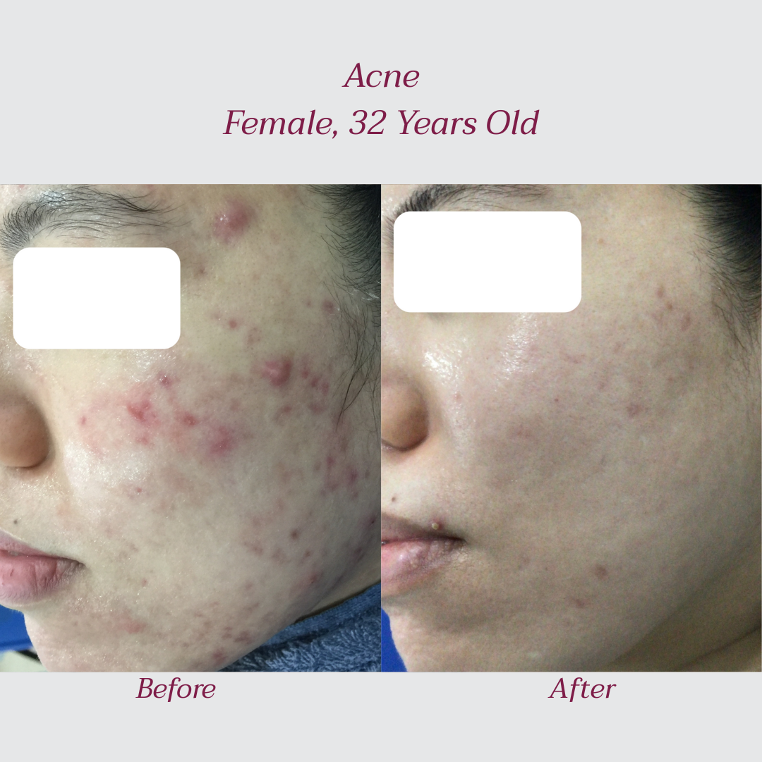 Reglo_Acne.png