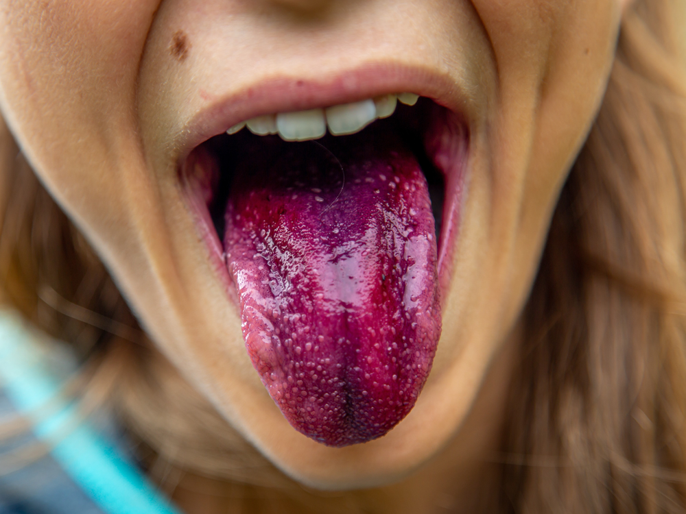 This is why you need to brush your tongue...