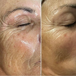 Before & After Skin 1.jpeg