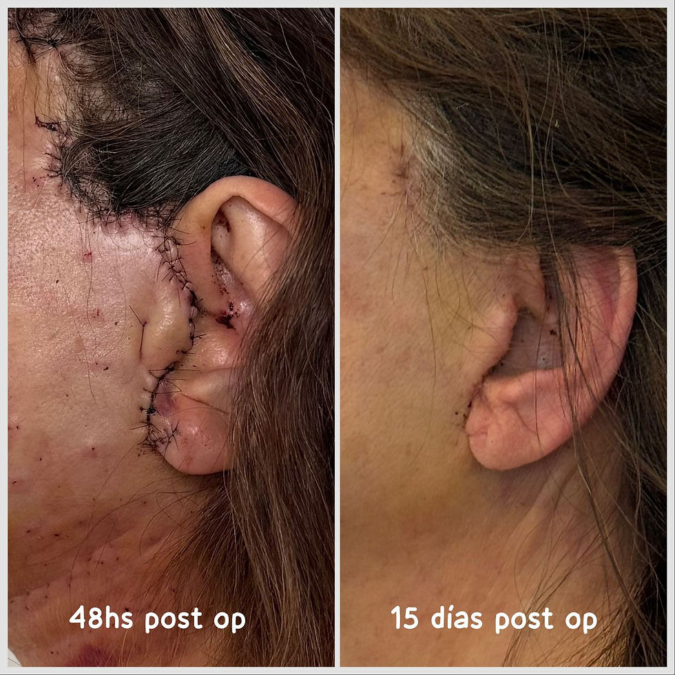 Cicatrices 48 hrs y 15 dias