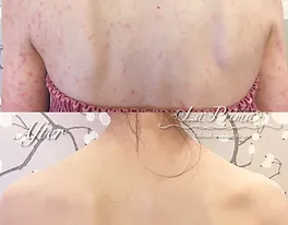 肌荒れ 傷痕を隠すメイク例 ブライダルボディメイク La Prima 大阪