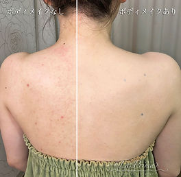 ニキビ ニキビ痕メイク例 ブライダルボディメイク La Prima 大阪