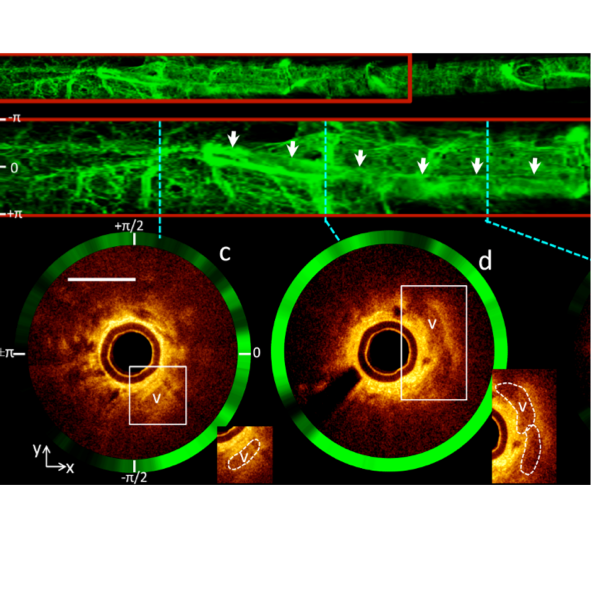 In vivo OCT endoscopy