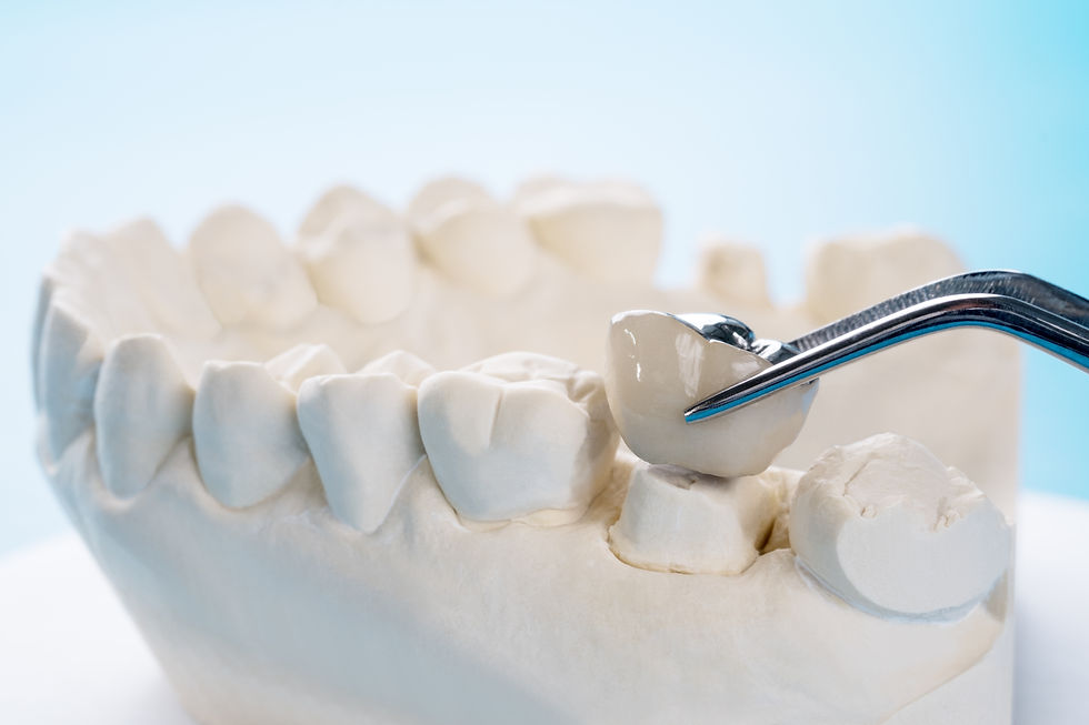 close-up-implan-model-tooth-support-fix-bridge-implan-crown.jpg