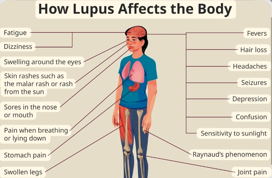 Lupus Formula Liquid - (15 mL)