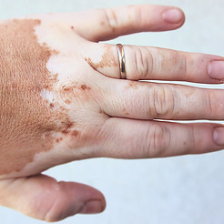 Close-up of a hand with noticeable patches of depigmented skin, likely affected by a condition such as vitiligo.