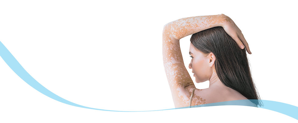 Person with vitiligo on their arm, symbolizing treatment options for skin depigmentation available at Medical & Surgical Dermatology, Singapore.