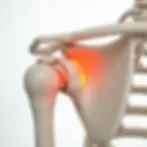 Shoulder Replacement
