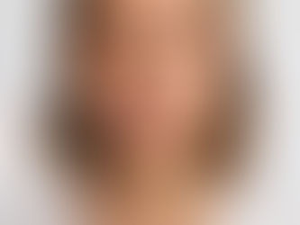Overfilled face: gdy estetyka traci naturalne proporcje