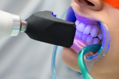 CLAREAMENTO DENTAL A LASER