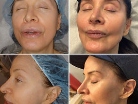 Skin Rejuvenation at Tu Es Belle Spa